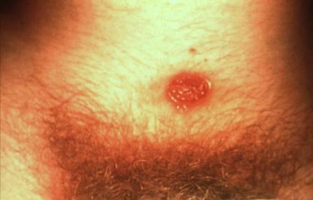 Syphilis Picture : Penis Chancre (Hardin MD / CDC)